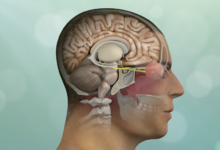 Brain Tumors Explained: Symptoms, Diagnosis, and Recovery