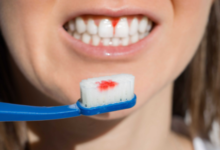 Bleeding Gums? Here's When to Worry
