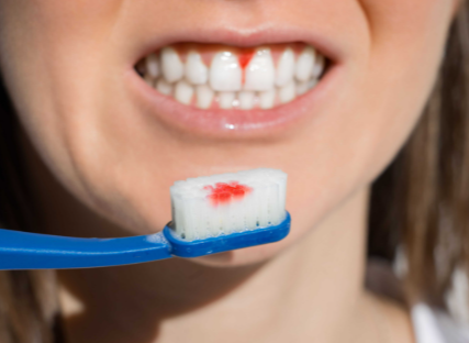 Bleeding Gums? Here's When to Worry