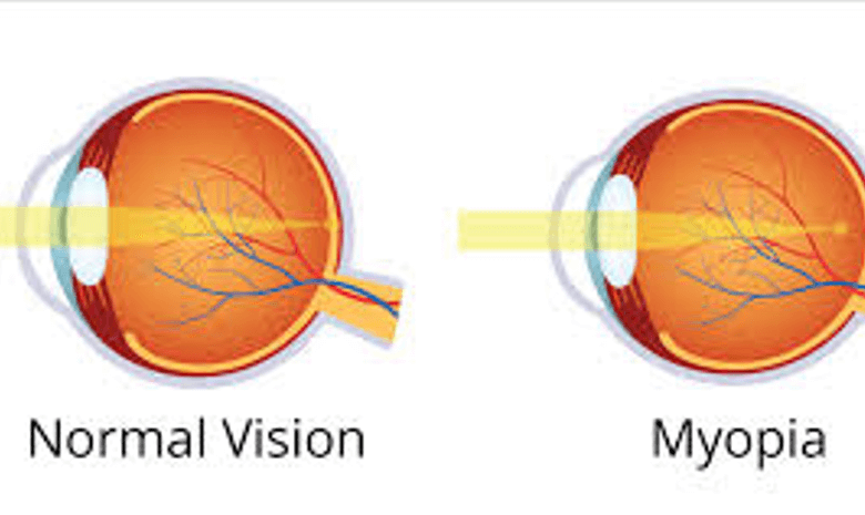 Lifestyle Tips from Myopia Clinics to Slow Down Nearsightedness
