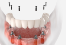 Korea Dentist Implant Cost and What Patients Should Know