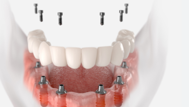 Korea Dentist Implant Cost and What Patients Should Know