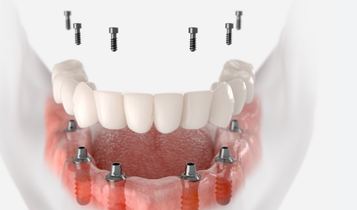 Korea Dentist Implant Cost and What Patients Should Know