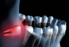 25 Foods to Eat After Wisdom Teeth Removal