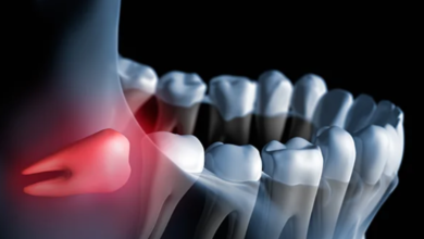25 Foods to Eat After Wisdom Teeth Removal