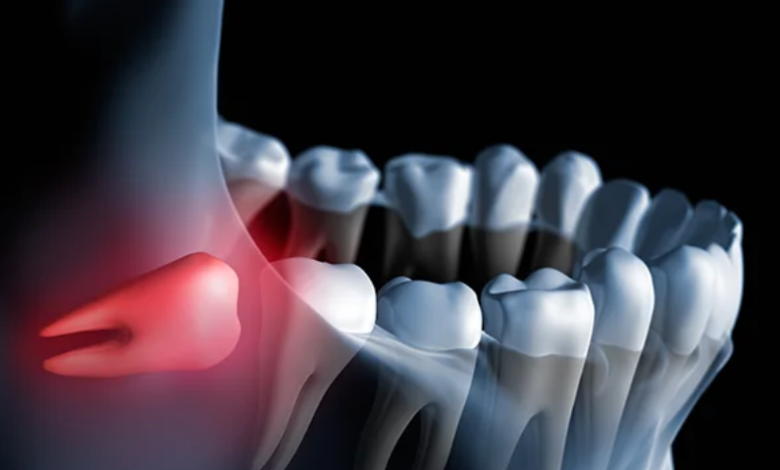 25 Foods to Eat After Wisdom Teeth Removal