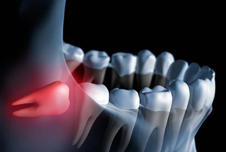 25 Foods to Eat After Wisdom Teeth Removal